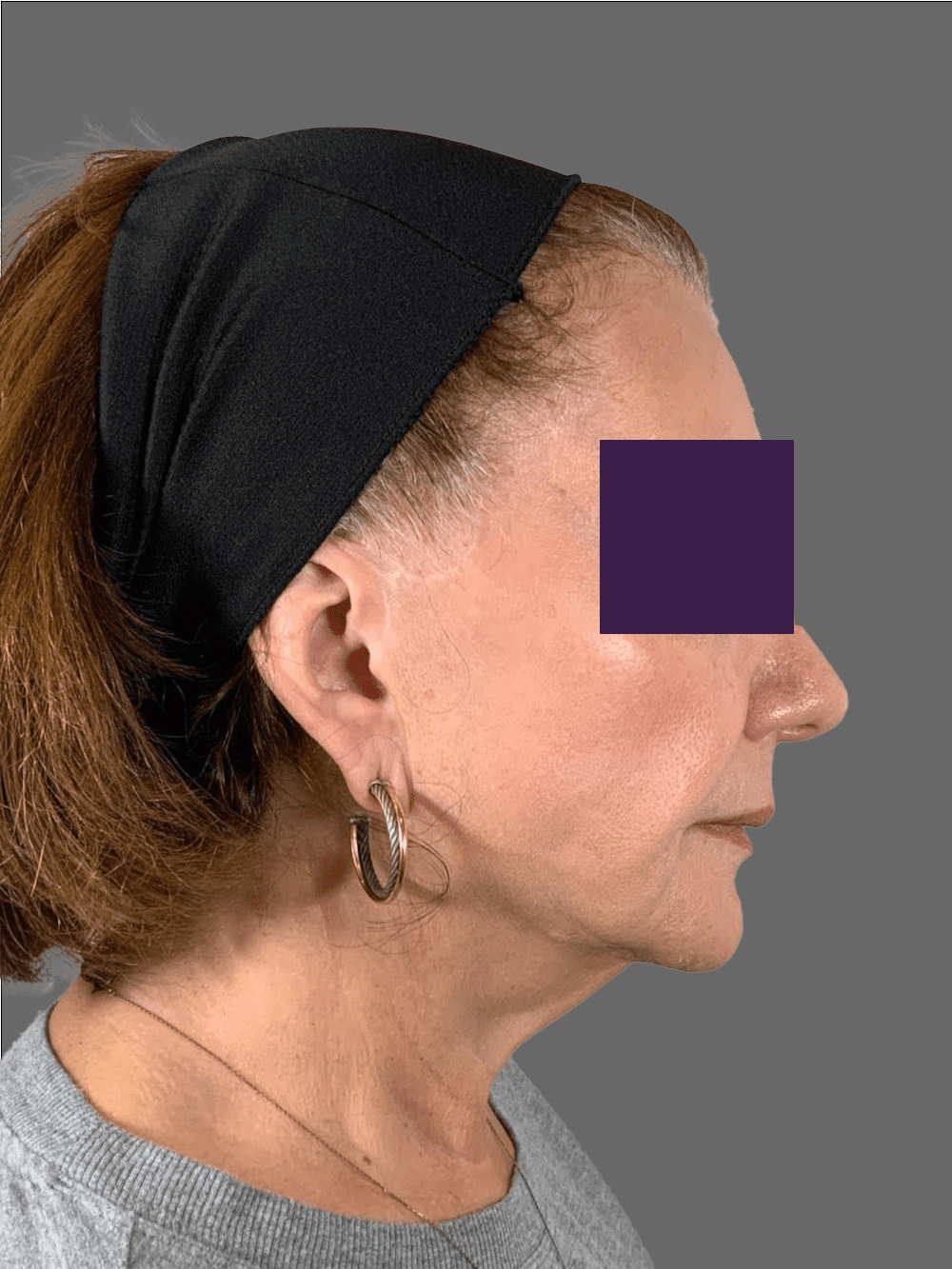 Renuva Patient Photo - Case 4291 - before view-4