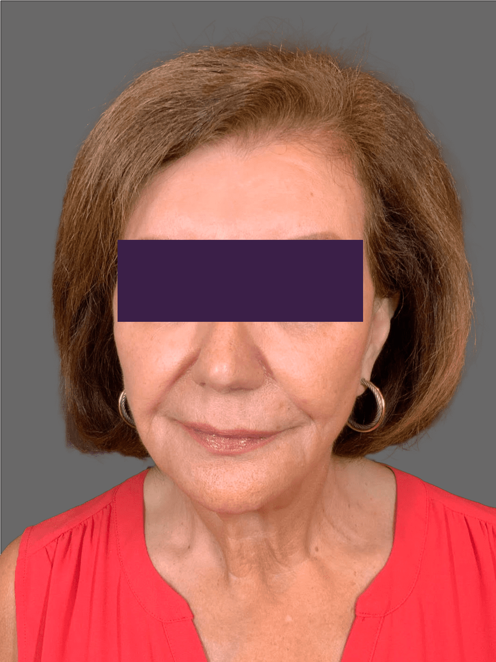 Renuva Patient Photo - Case 4291 - after view