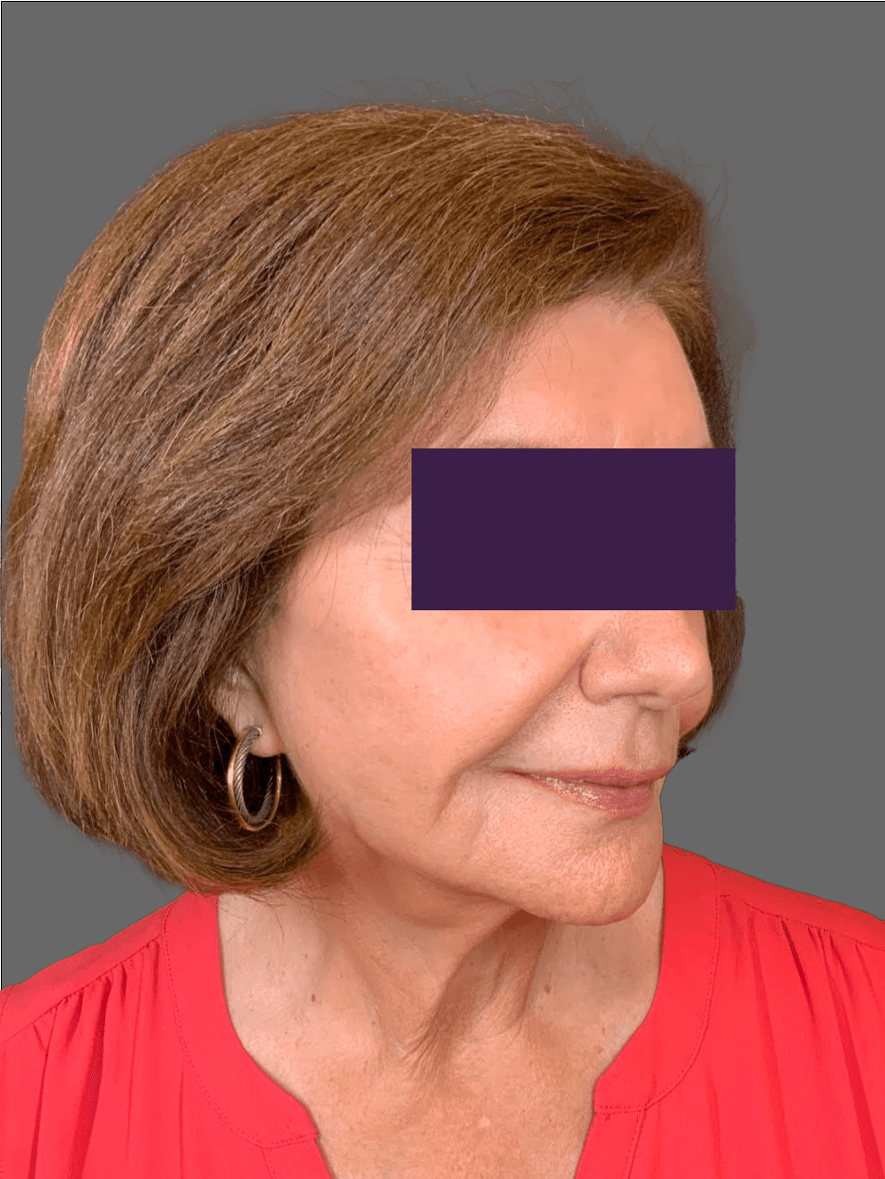 Renuva Patient Photo - Case 4291 - after view-2