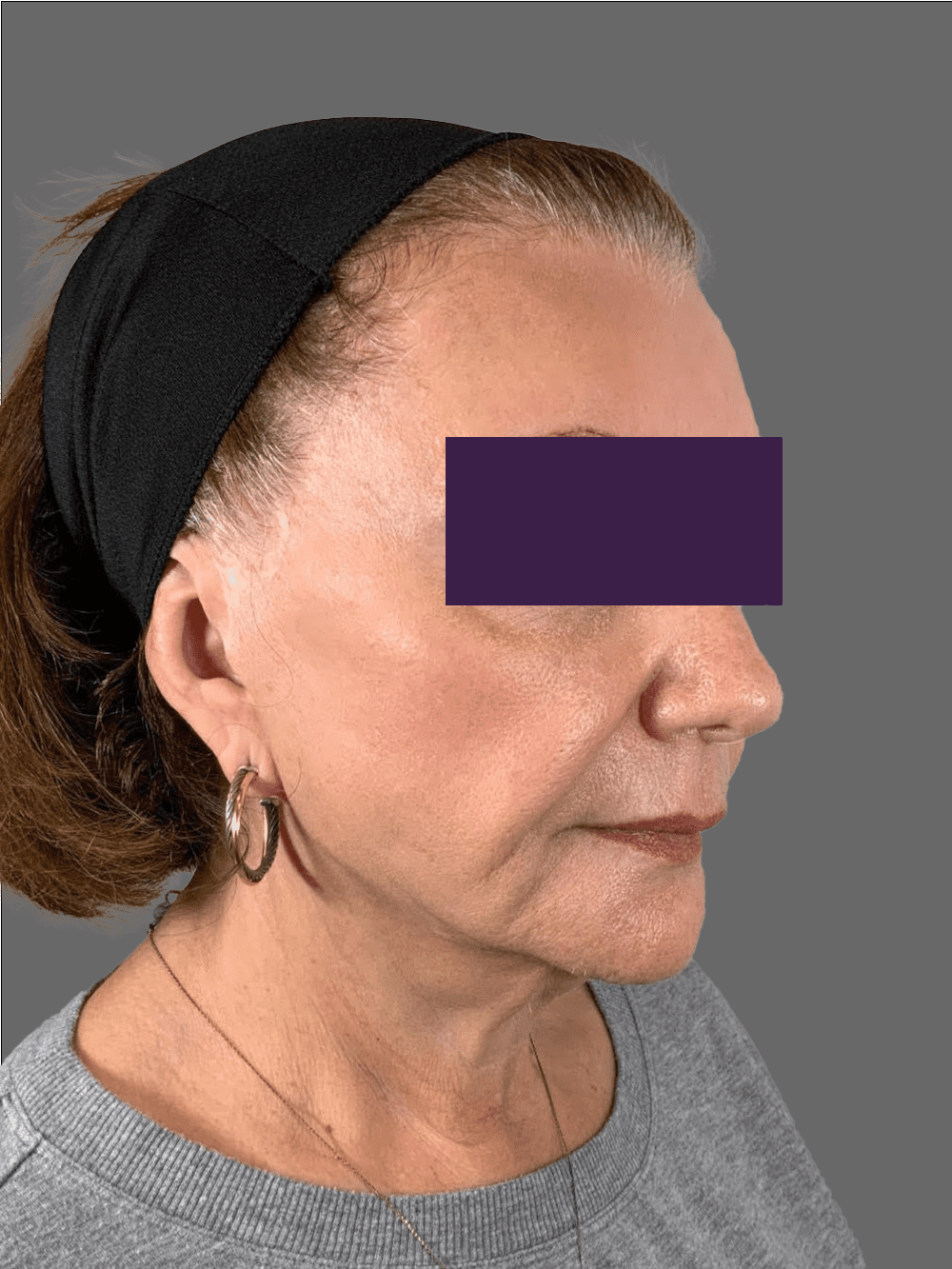 Renuva Patient Photo - Case 4291 - before view-2