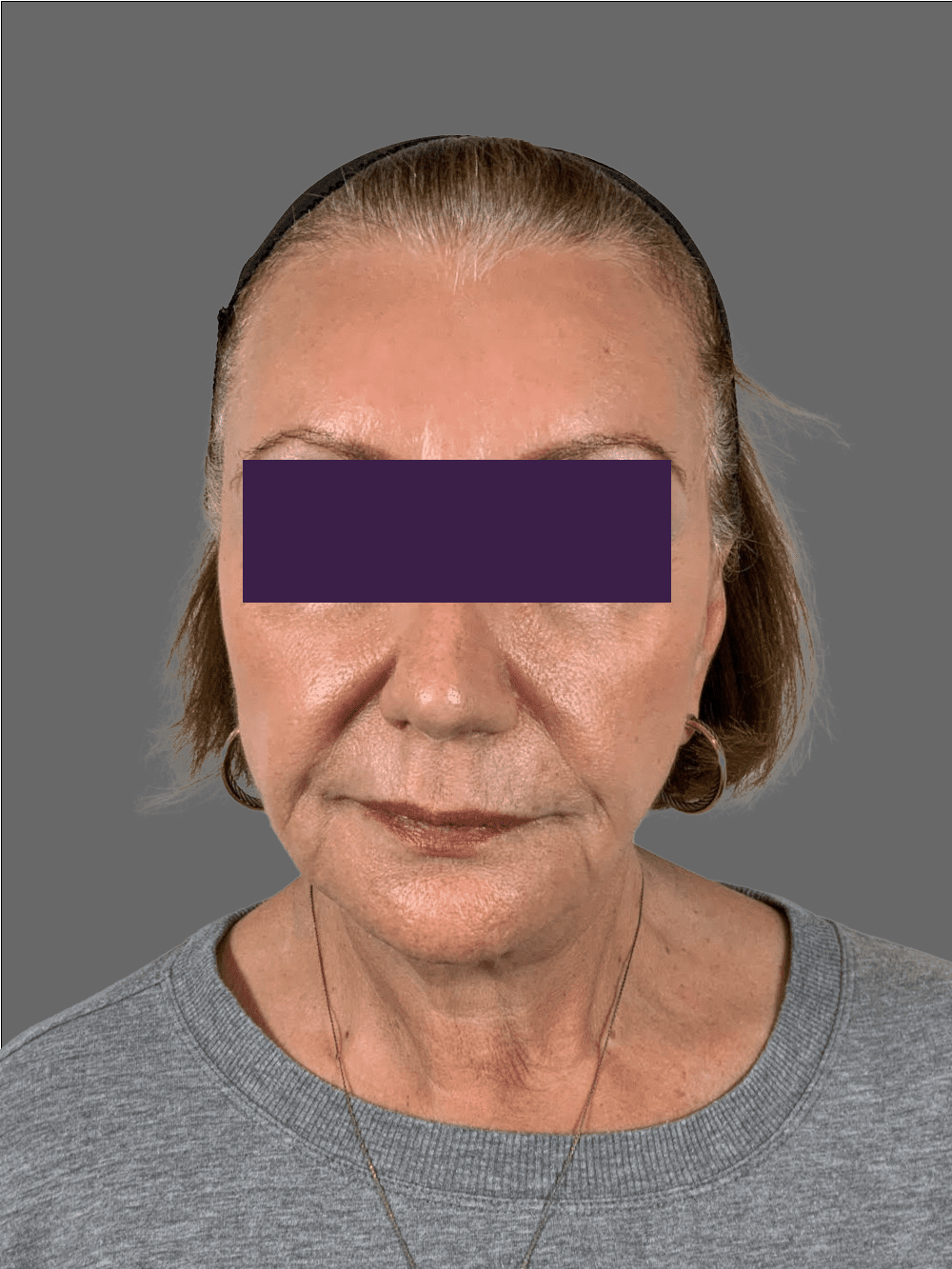 Facial Fillers Patient Photo - Case 4291 - before view-