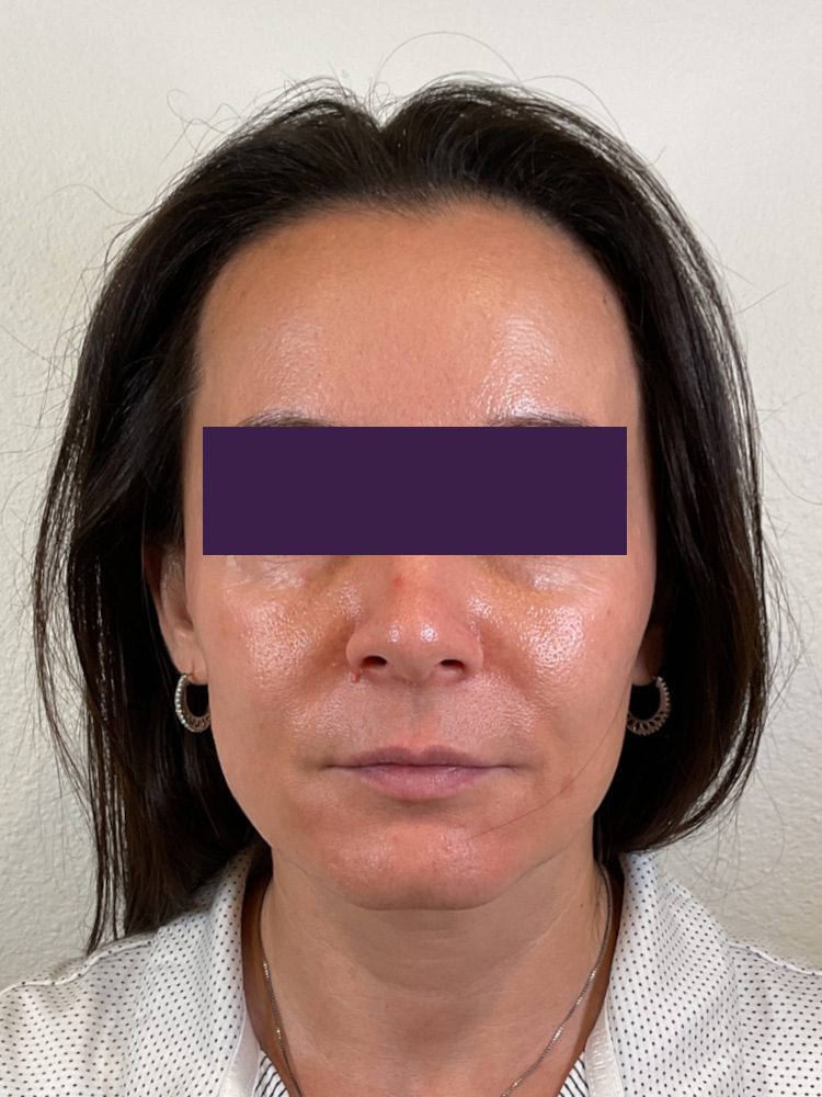BOTOX® Cosmetic - Case 4362 - Before