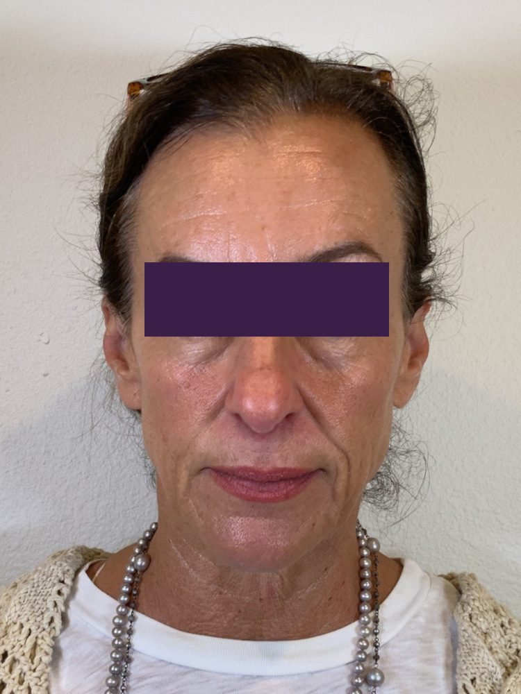 BOTOX® Cosmetic - Case 4385 - Before