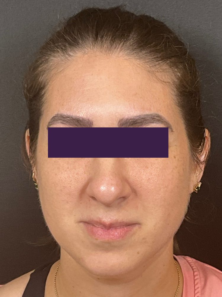 BOTOX® Cosmetic - Case 4403 - After
