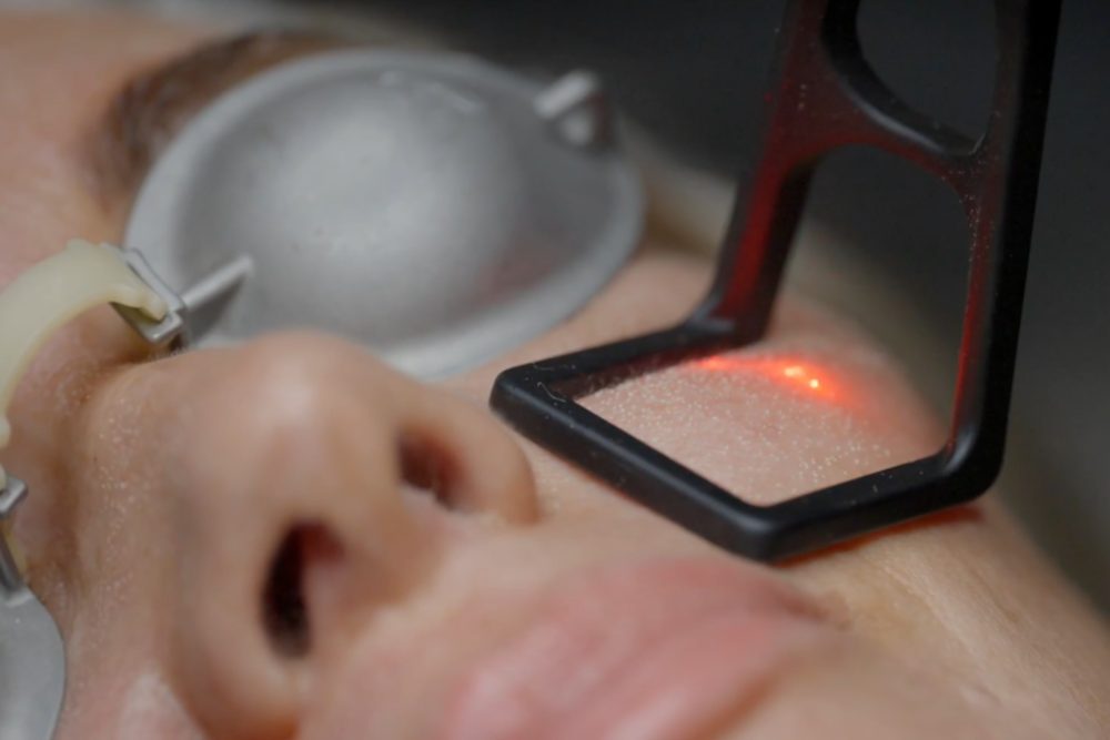 What’s So Cool About the CoolPeel® Laser Treatment?