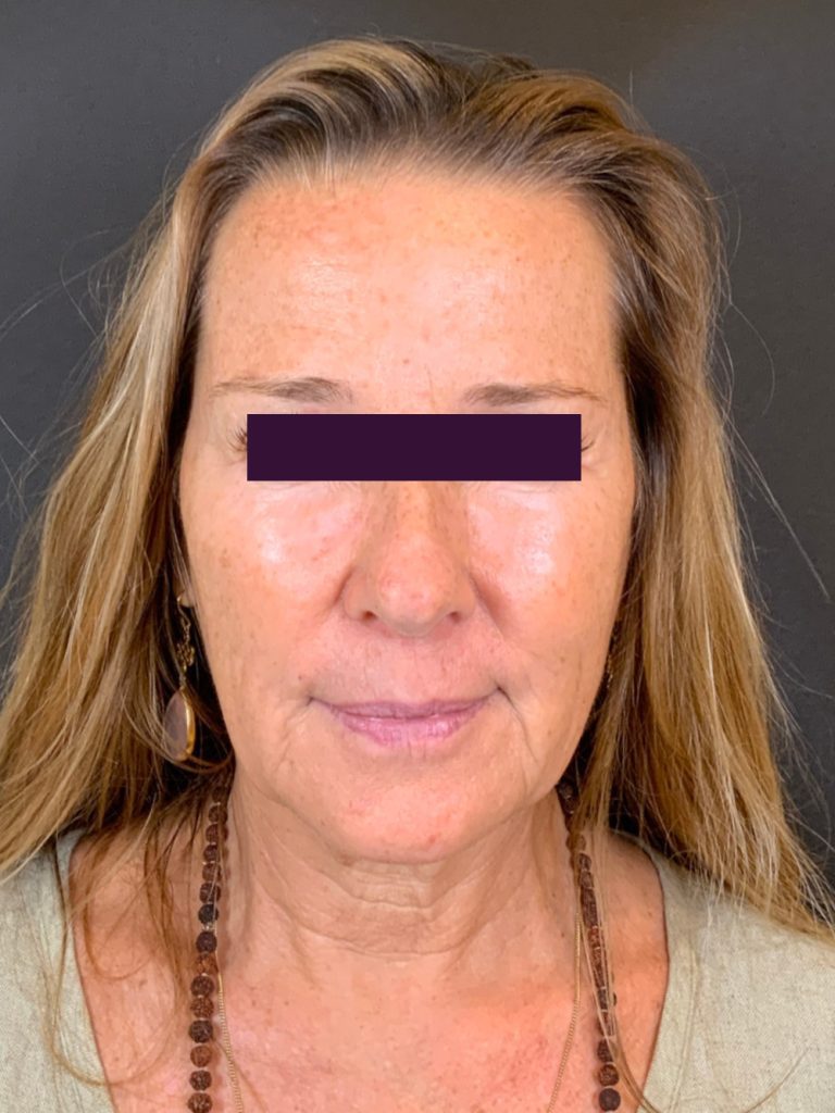 Facial Fillers - Case 5933 - Before