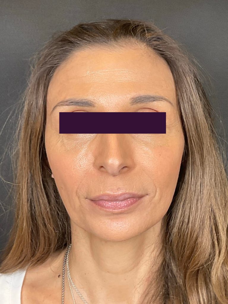 Dysport Cosmetic - Case 5941 - After