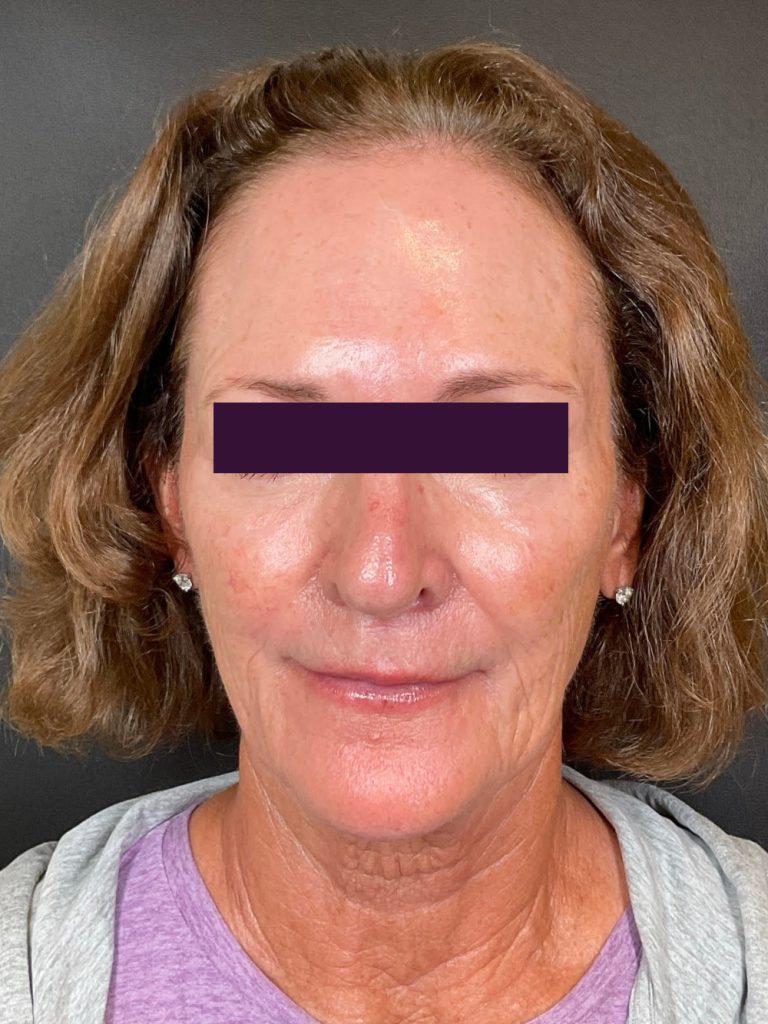 BOTOX® Cosmetic - Case 5945 - After