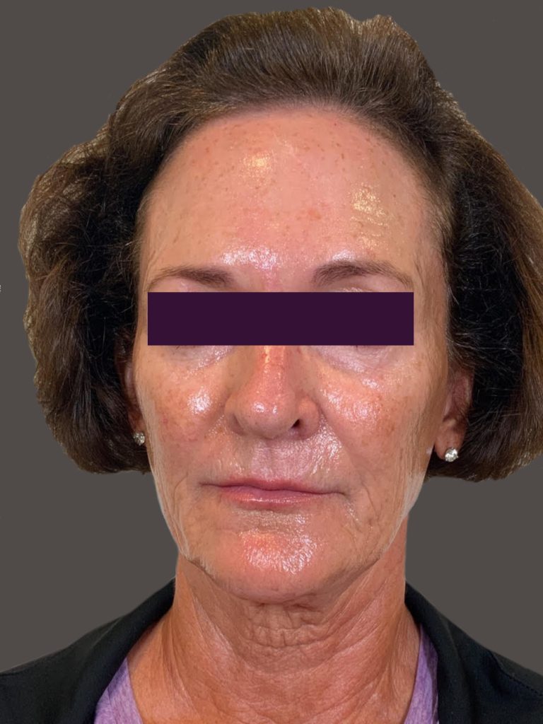 BOTOX® Cosmetic - Case 5945 - Before