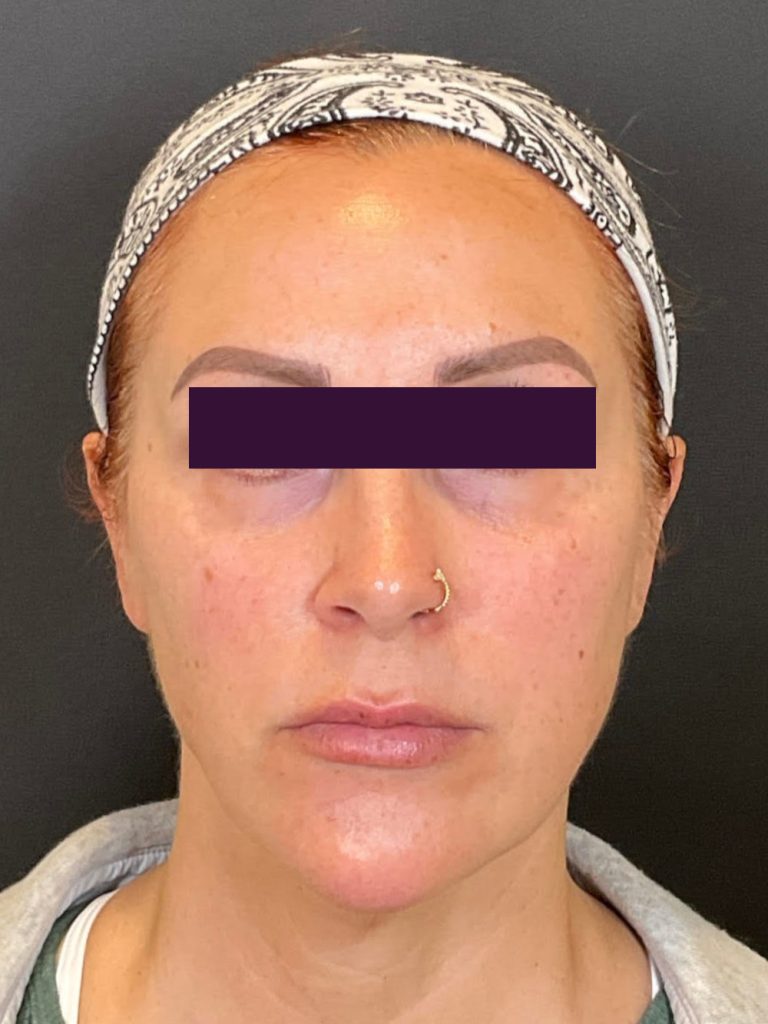 Dysport Cosmetic - Case 5951 - Before