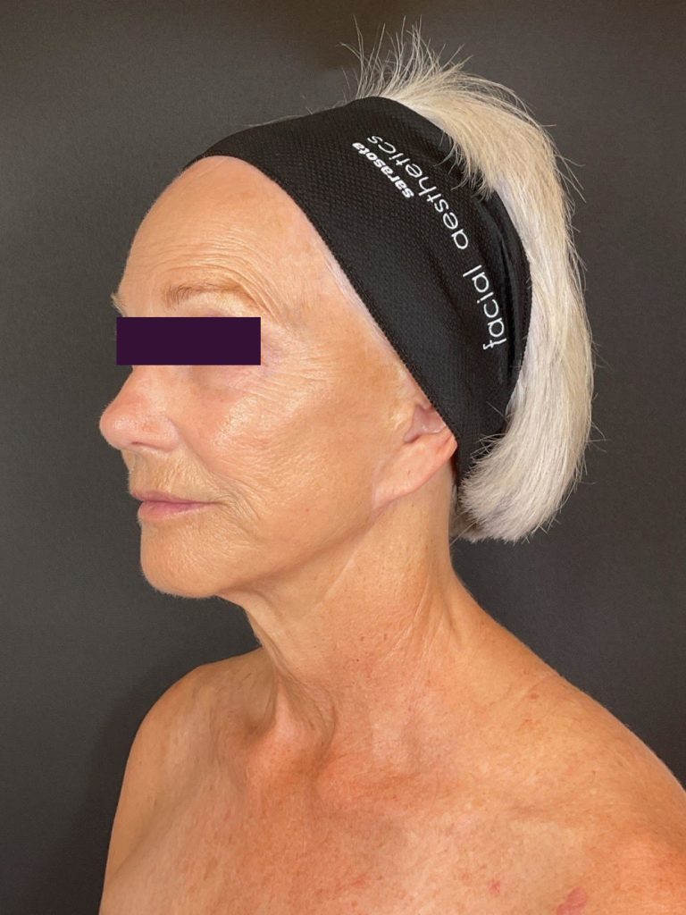 CO2 Laser - Case 5959 - After