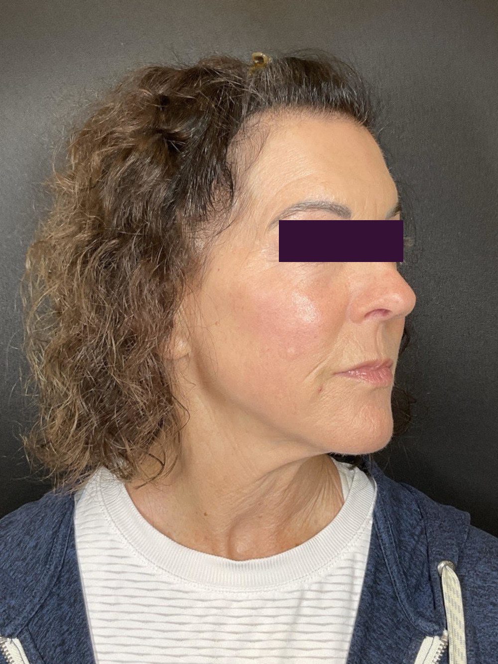 CO2 Laser Patient Photo - Case 5963 - after view