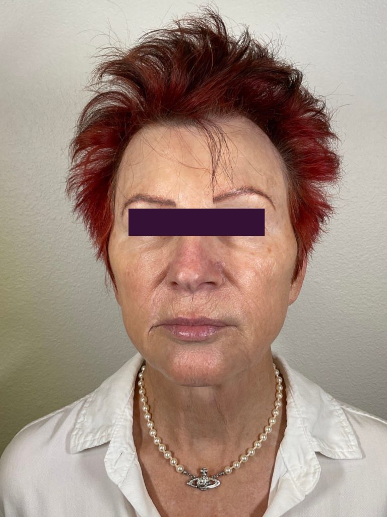 Renuva - Case 5967 - Before