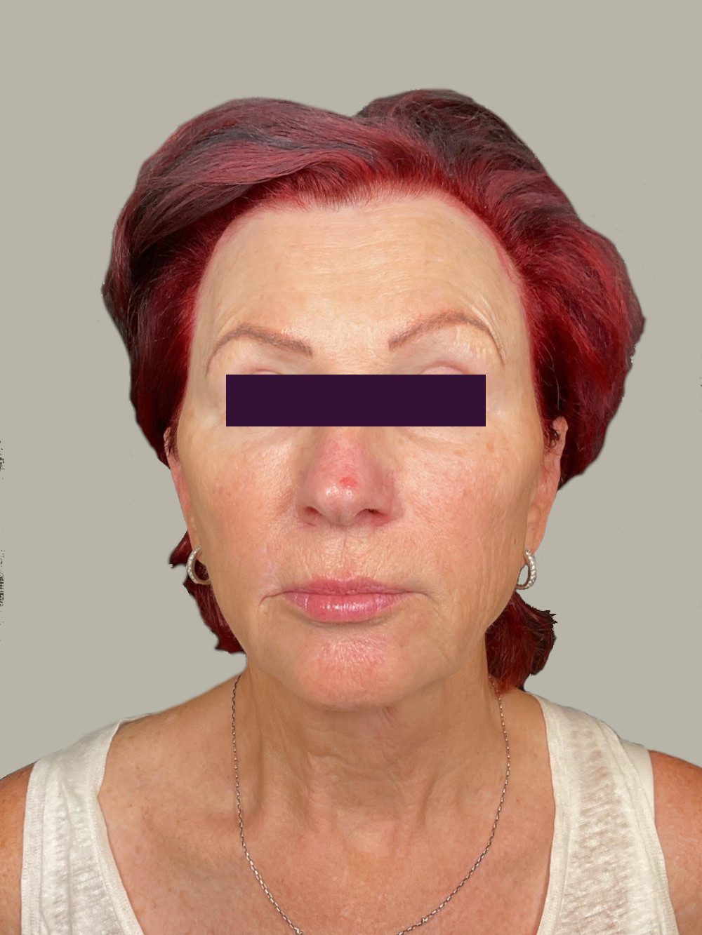 Renuva Patient Photo - Case 5967 - after view