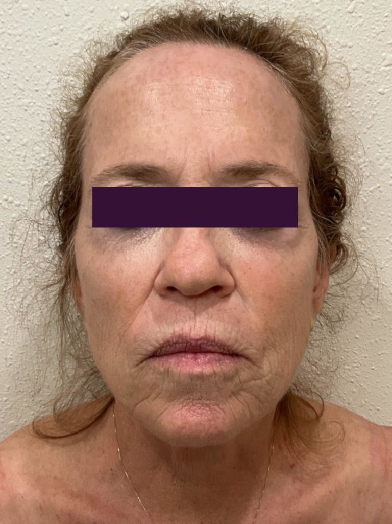 BBL /IPL - Case 5971 - Before