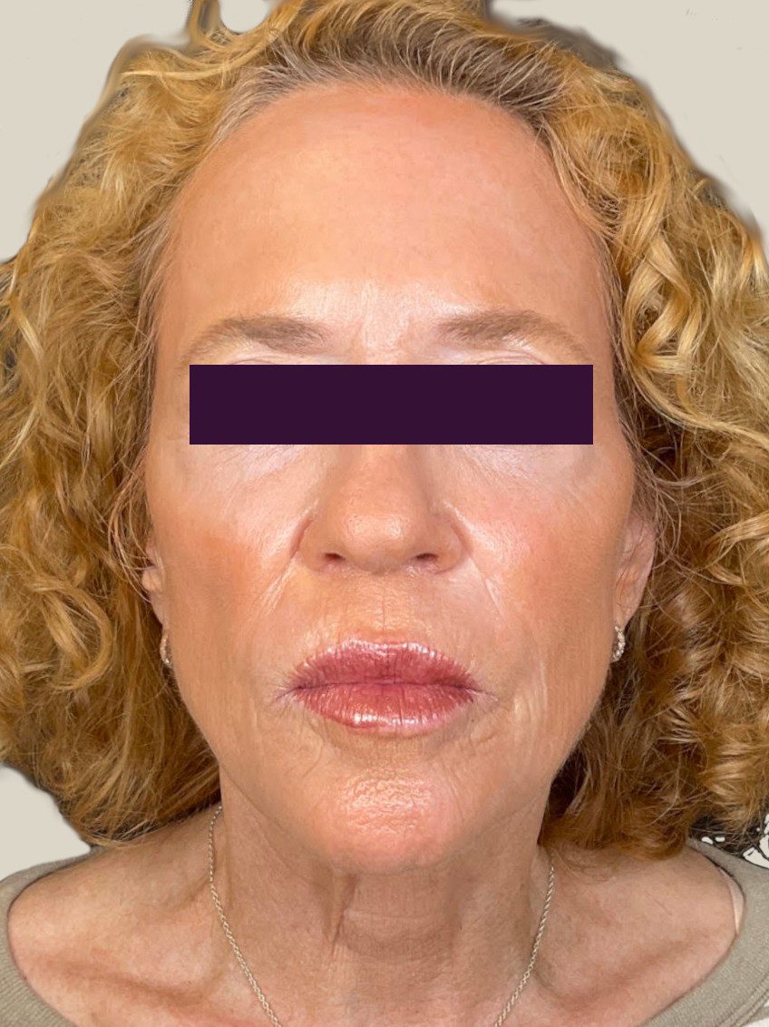 BBL /IPL Patient Photo - Case 5971 - after view