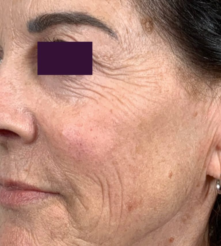 CO2 Laser - Case 5981 - Before