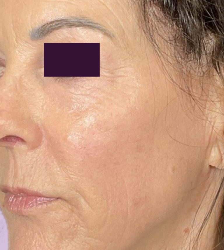 CO2 Laser - Case 5981 - After