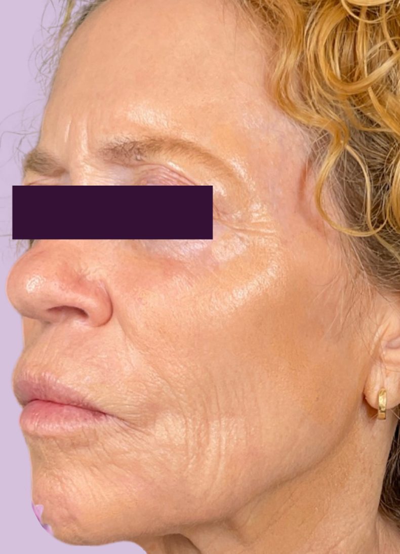 CO2 Laser Patient Photo - Case 5985 - after view