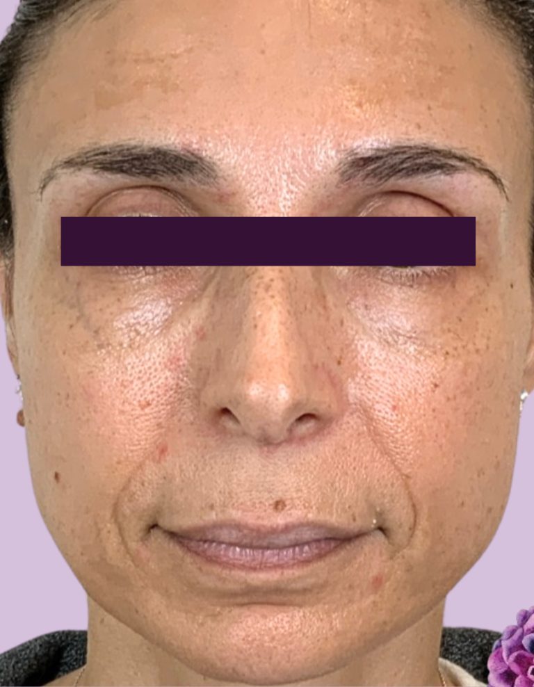 BOTOX® Cosmetic - Case 5993 - Before