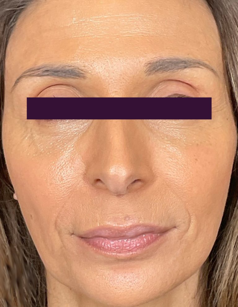 BOTOX® Cosmetic - Case 5993 - After