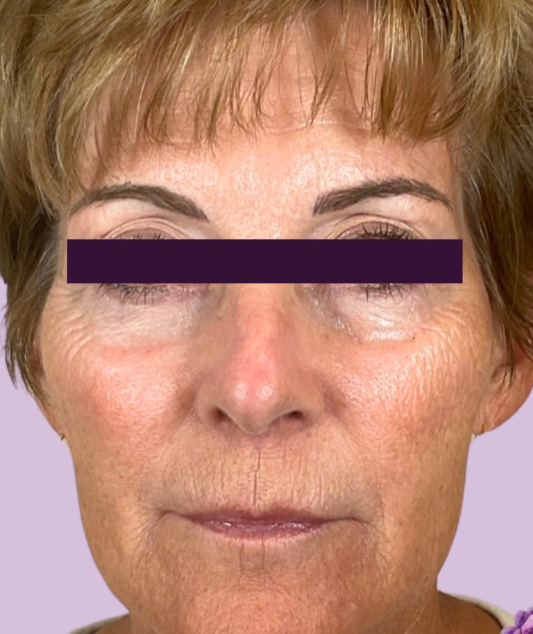 Renuva - Case 6001 - Before