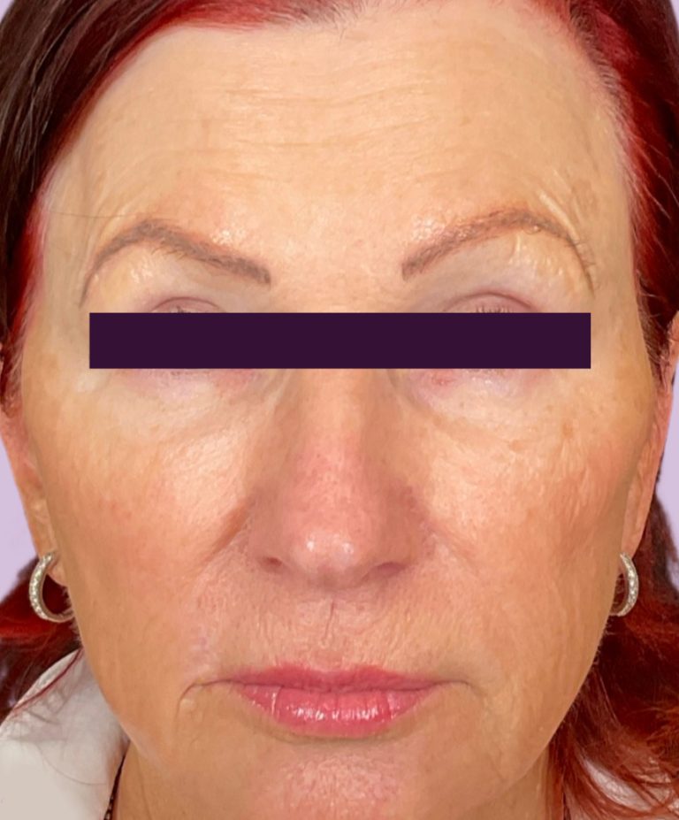 BBL /IPL - Case 6005 - After