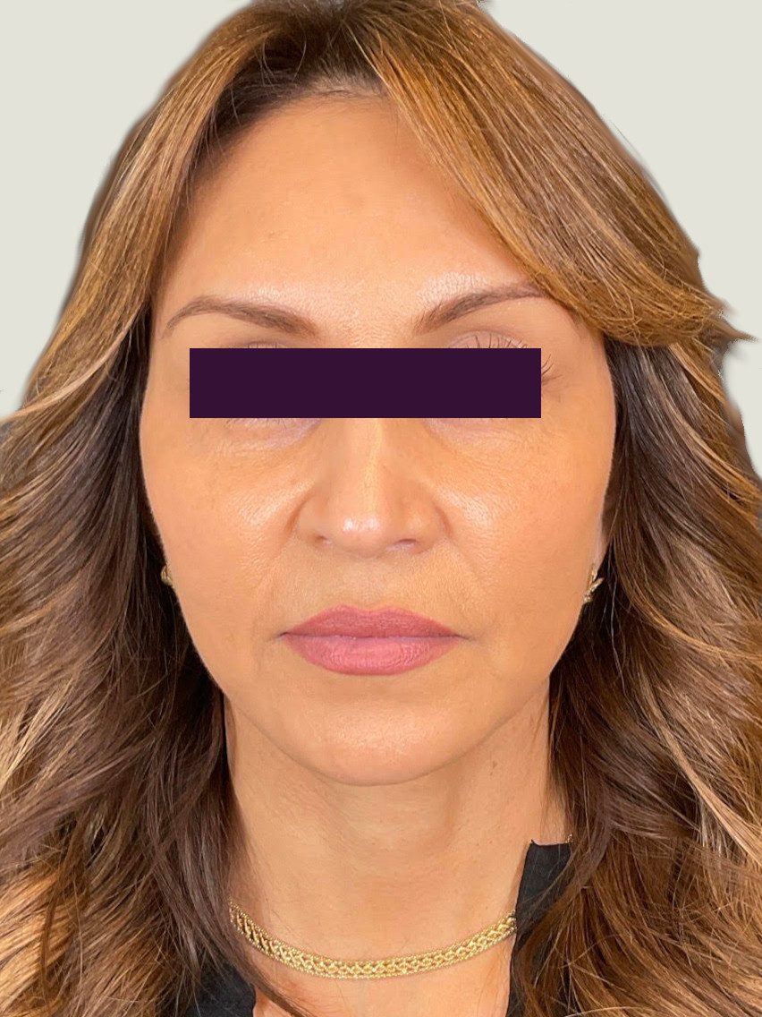 BOTOX® Cosmetic Patient Photo - Case 6015 - after view