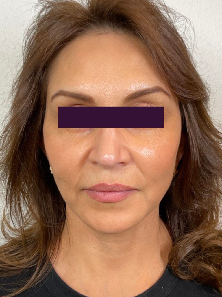 BOTOX® Cosmetic - Case 6015 - Before