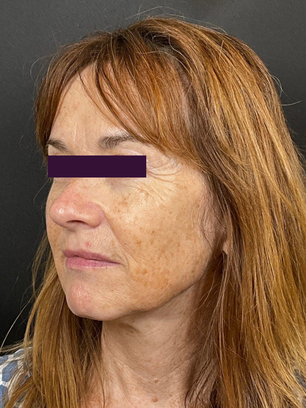 BBL /IPL Patient Photo - Case 6019 - before view-