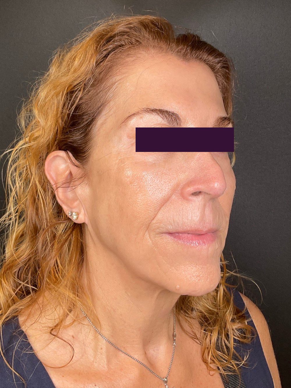 BBL /IPL Patient Photo - Case 6023 - after view