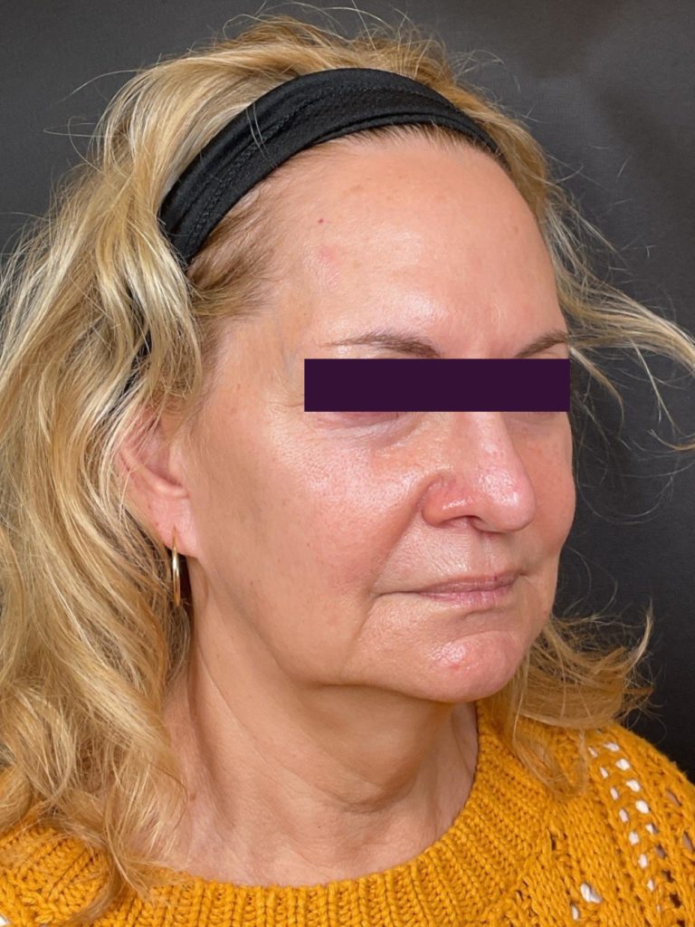 Renuva - Case 6031 - Before