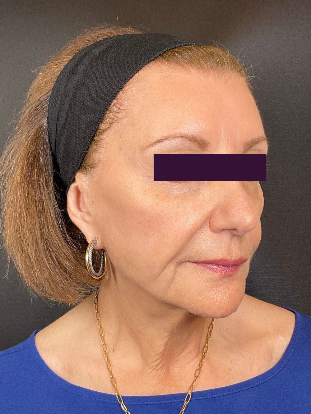 BOTOX® Cosmetic Patient Photo - Case 6035 - after view