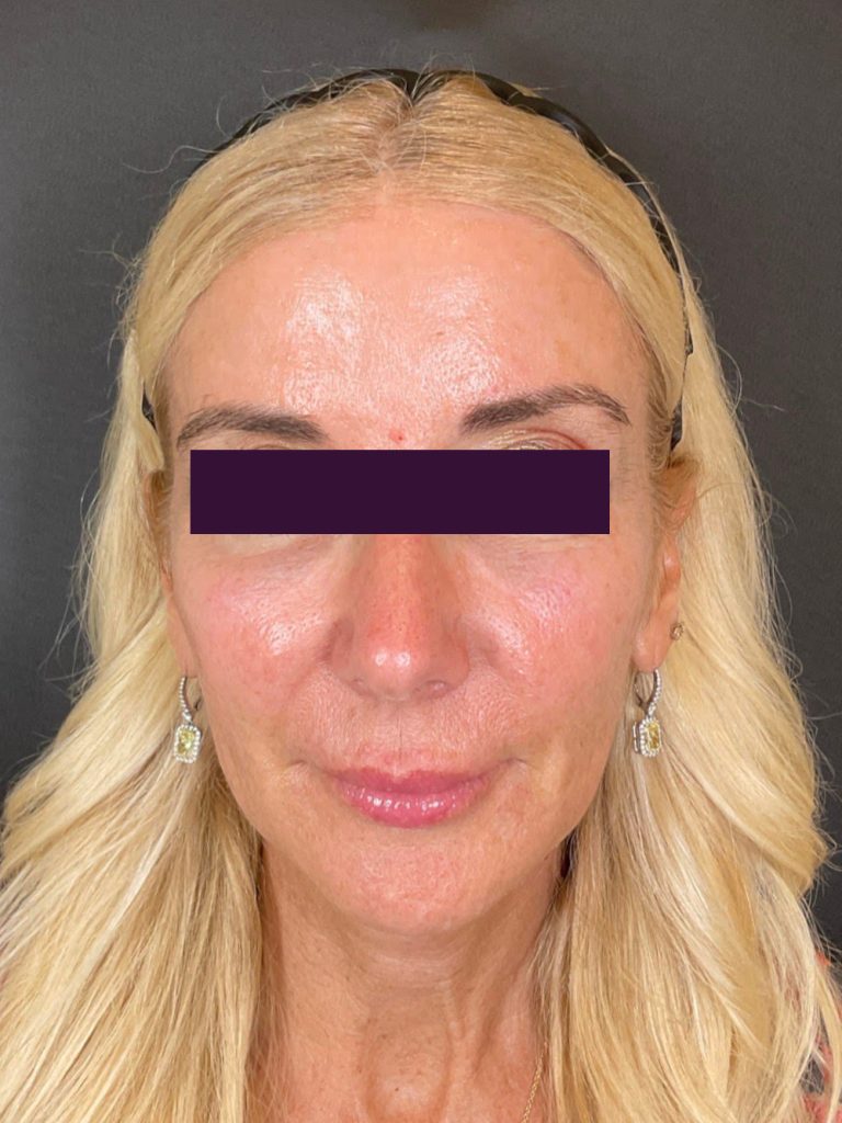 Renuva - Case 6039 - Before