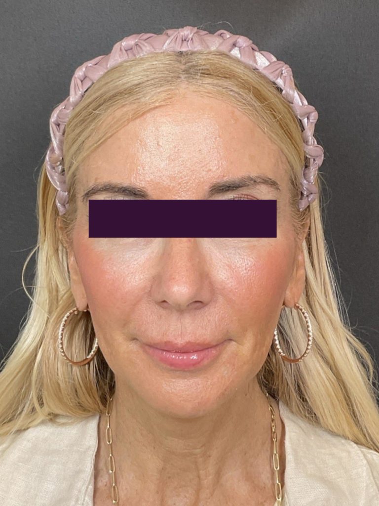 Renuva - Case 6039 - After