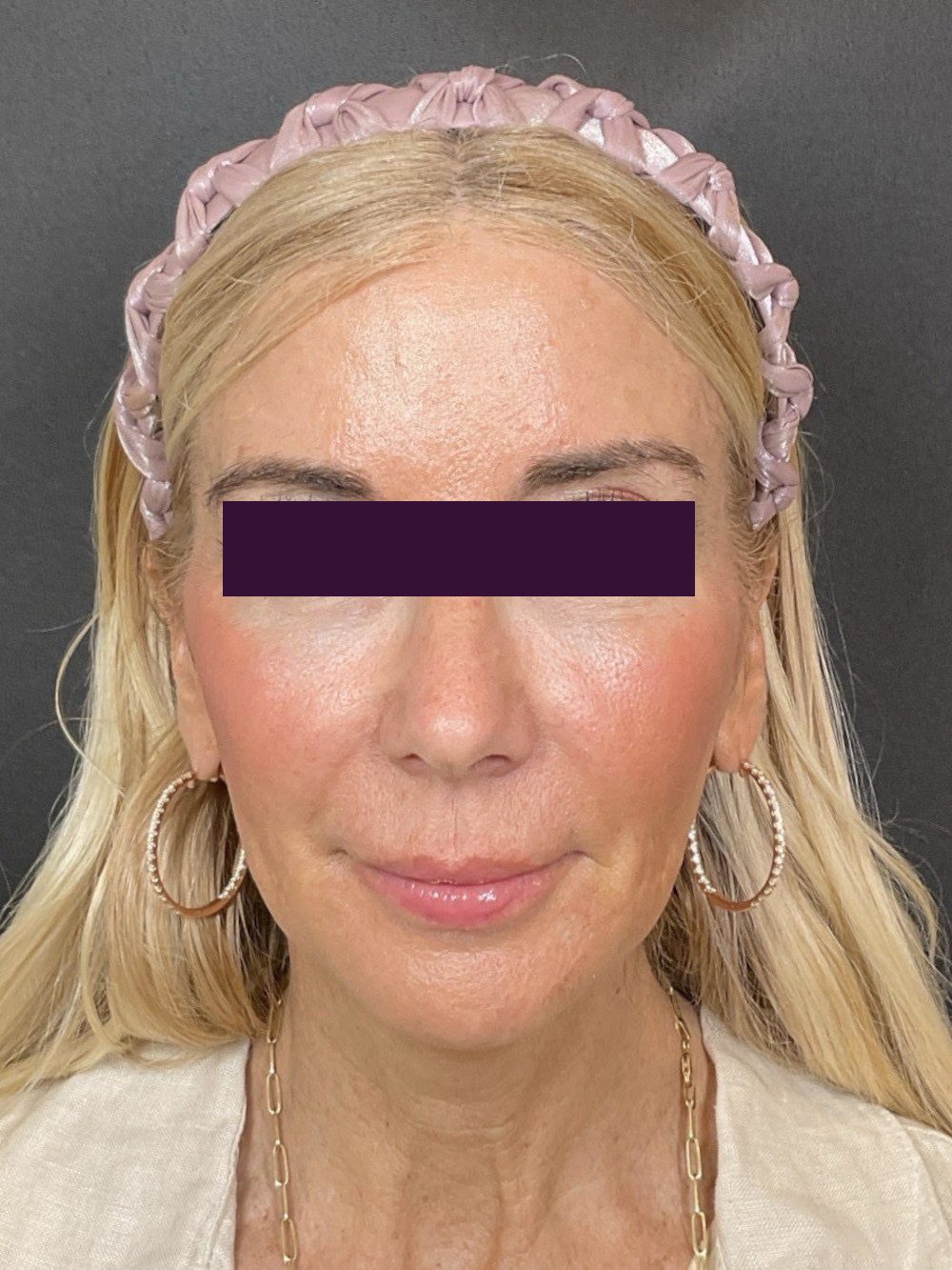 Renuva Patient Photo - Case 6039 - after view