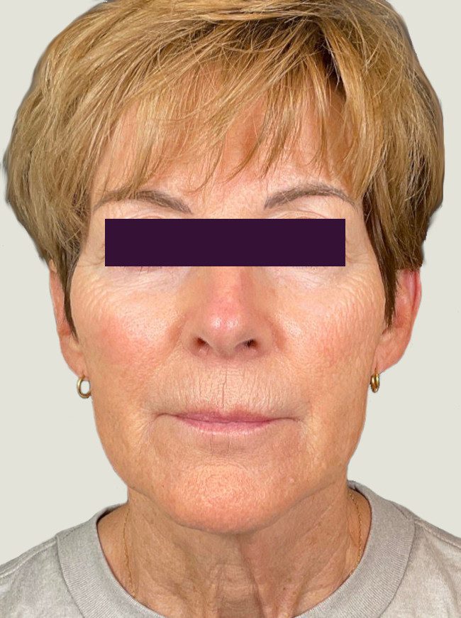 Renuva - Case 6043 - After