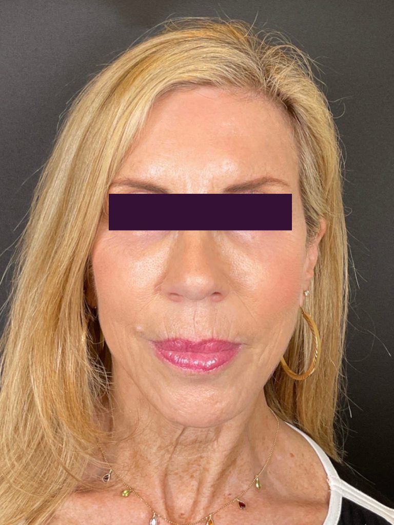 BBL /IPL - Case 6047 - After