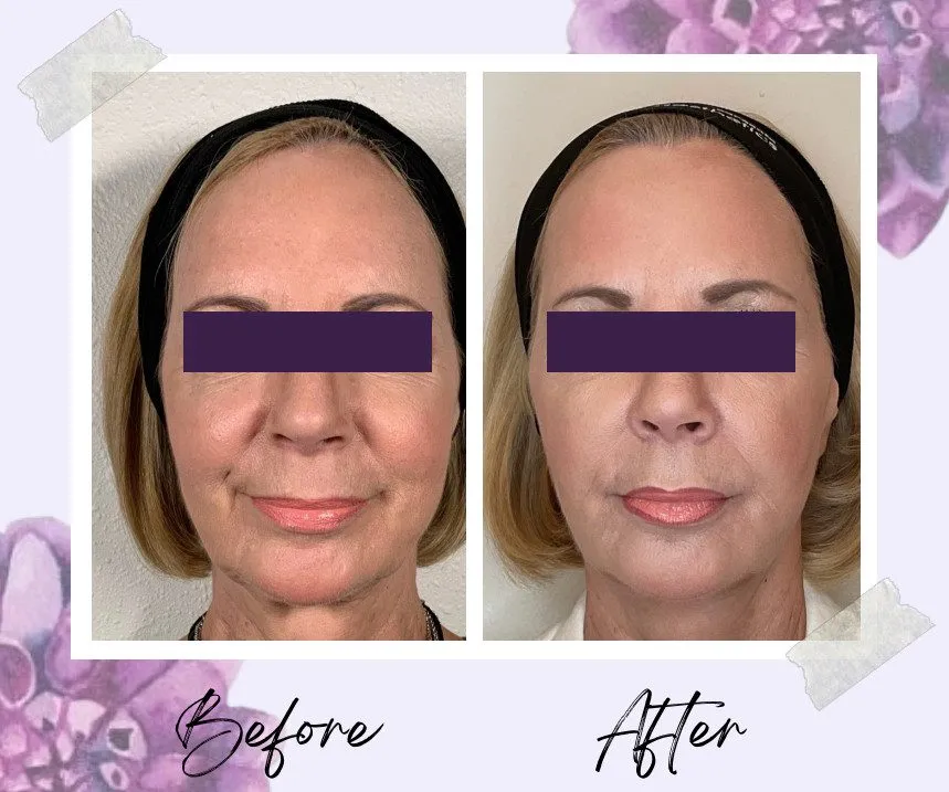 Dermal filler patient