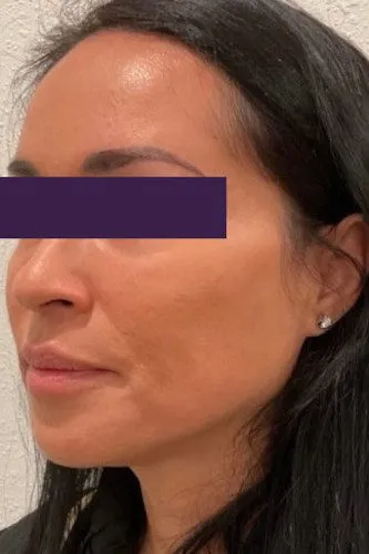 BBL /IPL Patient Photo - Case 3970 - after view-1