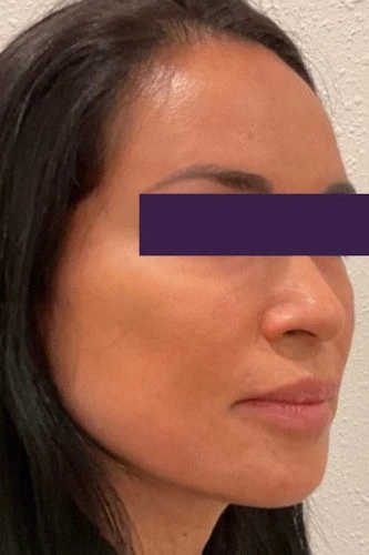BBL /IPL Patient Photo - Case 3970 - after view