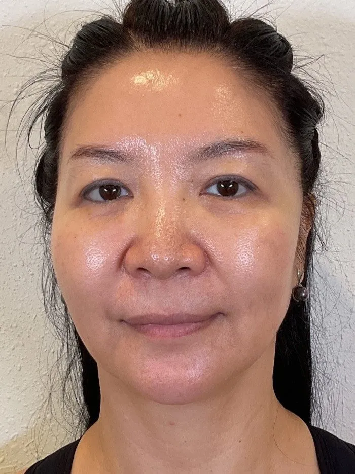 PDO Thread Lift Patient Photo - Case 4009 - after view