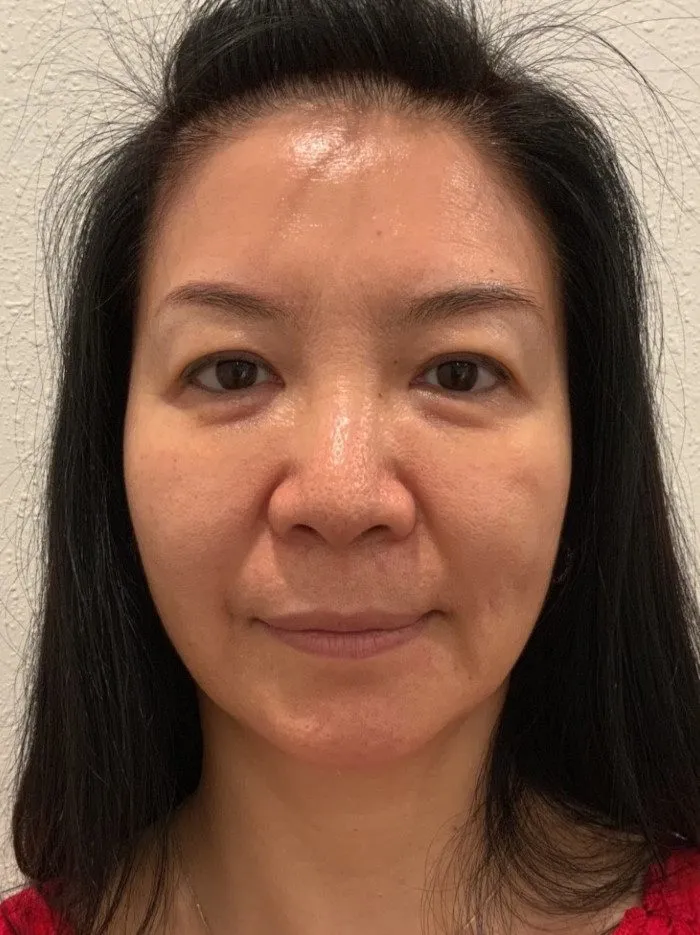 PDO Thread Lift Patient Photo - Case 4009 - before view-