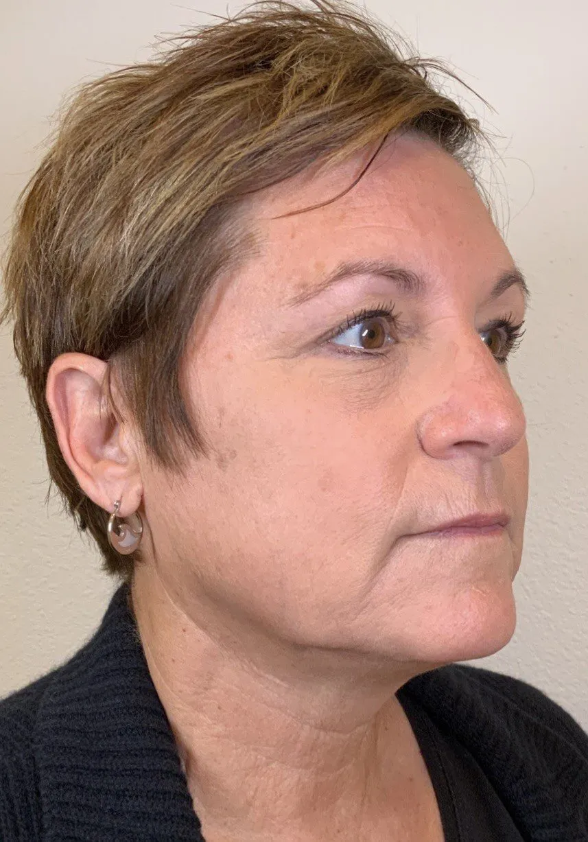 Facial Fillers Patient Photo - Case 4062 - before view-1