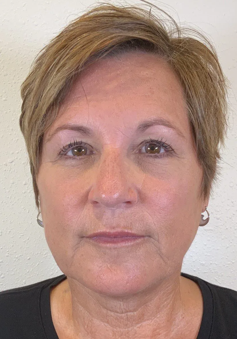 Facial Fillers Patient Photo - Case 4062 - after view