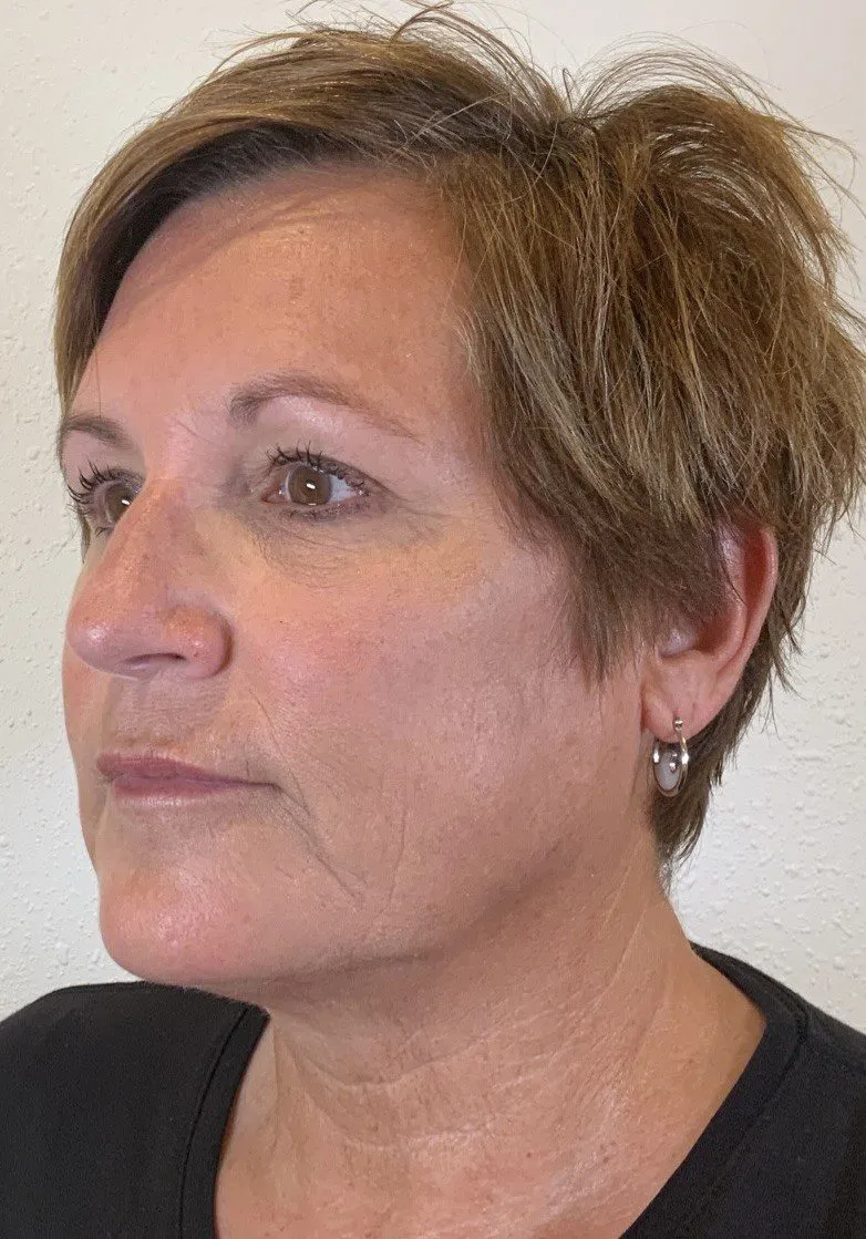 Facial Fillers Patient Photo - Case 4062 - after view-2