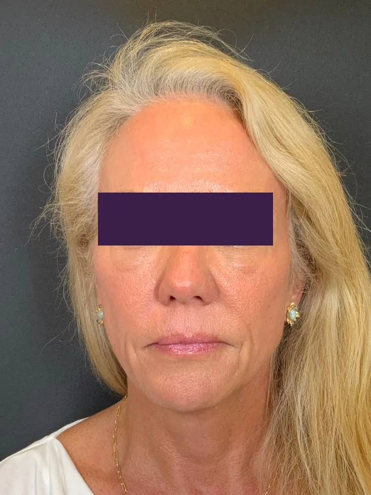 BOTOX® Cosmetic Patient Photo - Case 4353 - after view