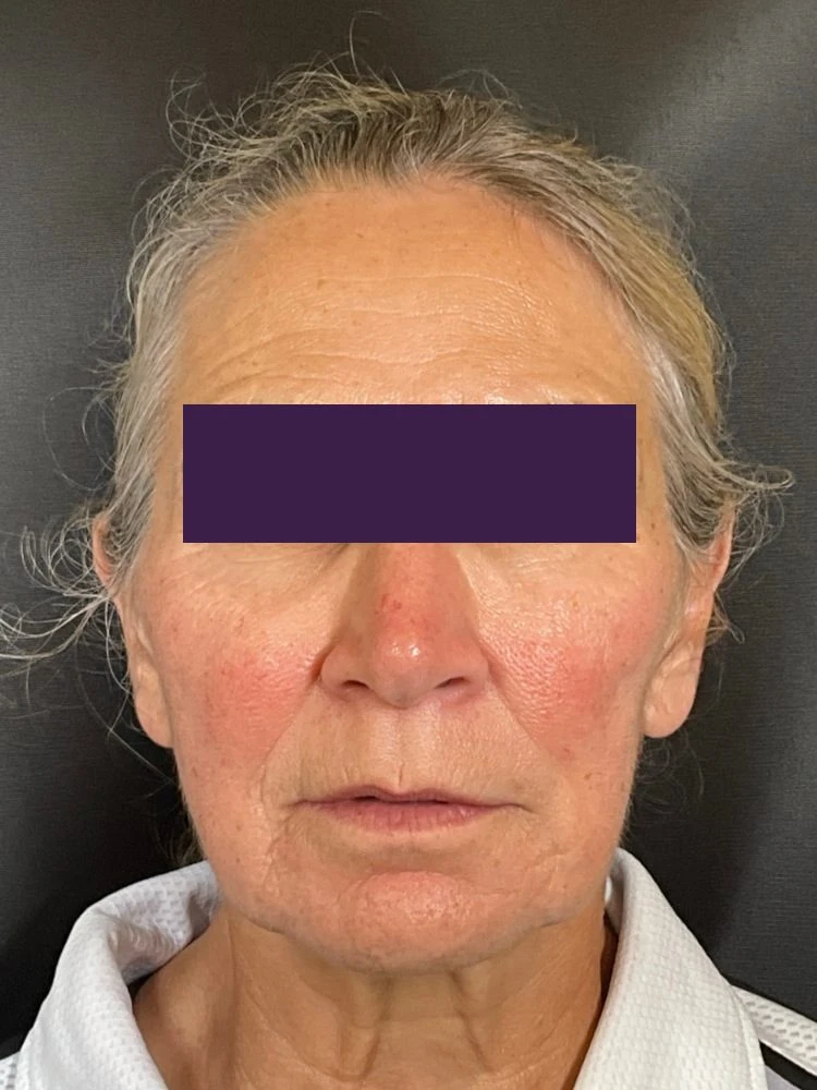 BOTOX® Cosmetic Patient Photo - Case 4365 - before view-