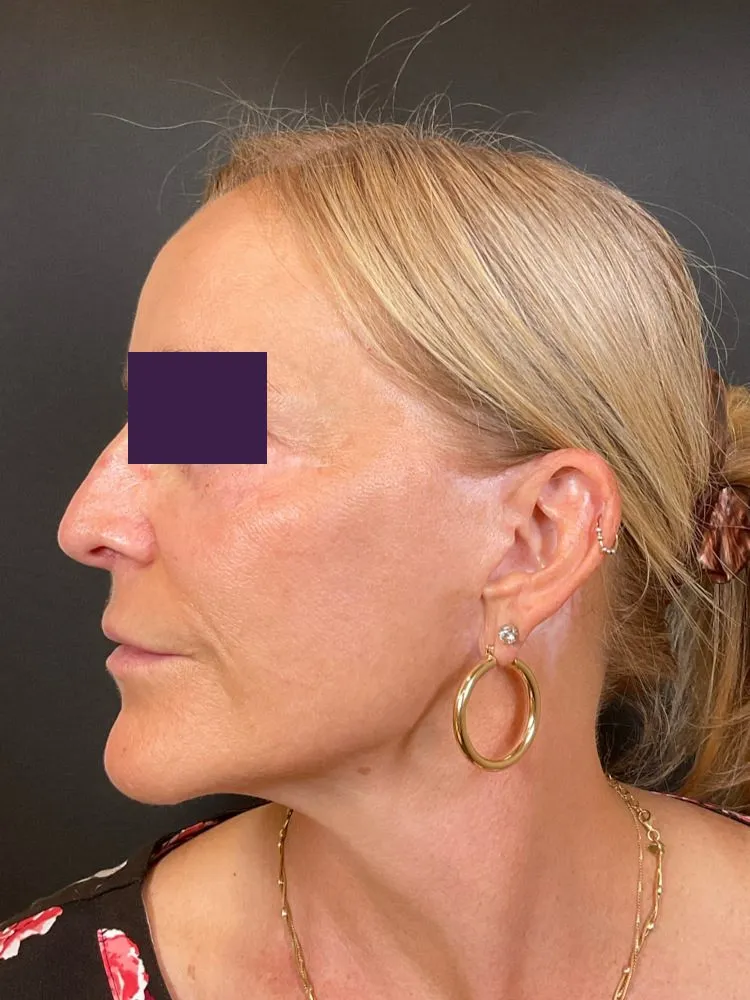 BBL /IPL Patient Photo - Case 4391 - after view