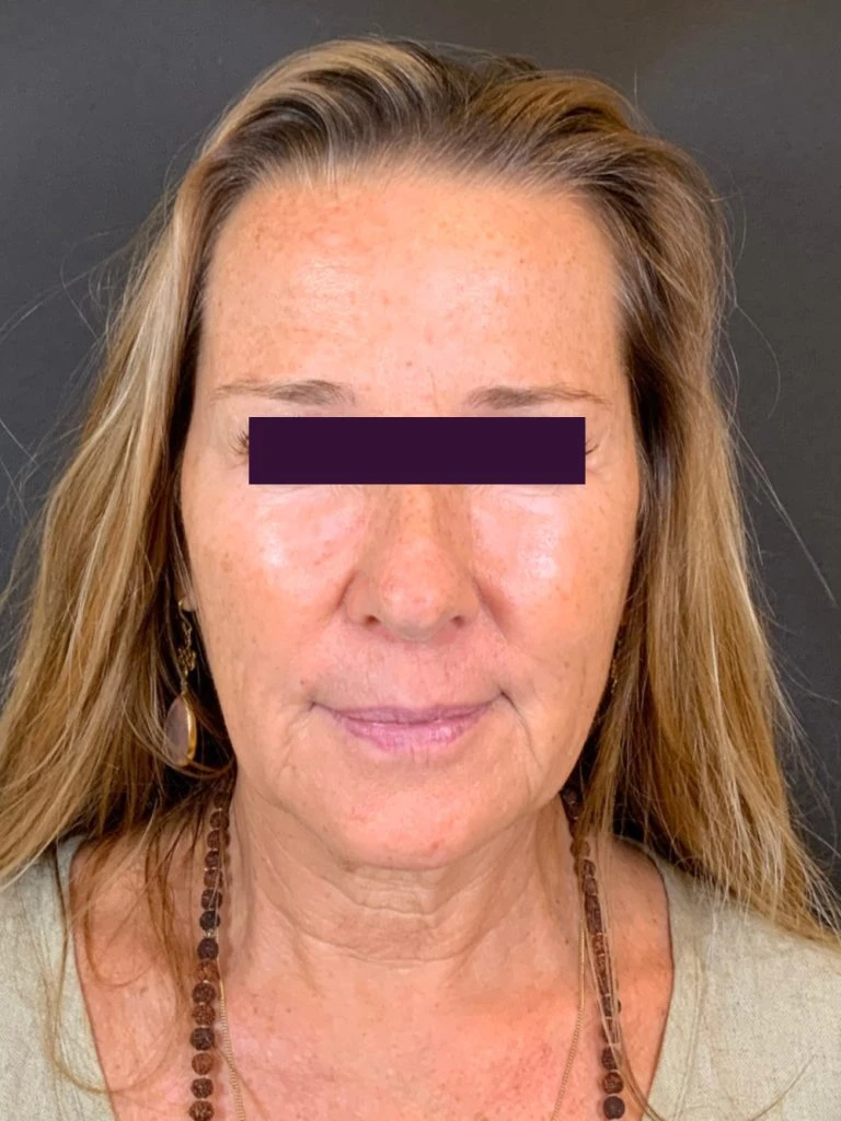 Facial Fillers - Case 5933 - Before